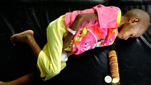 Indonesia's Papua province children starving in a land of gold